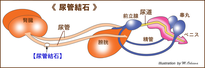 尿管結石