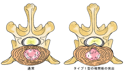 タイプ1型の椎間板の突出