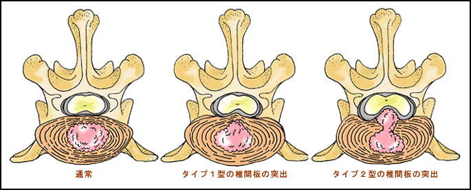 椎間板の突出、通常、タイプ１型、タイプ２型
