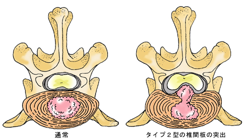 タイプ２型の椎間板の突出