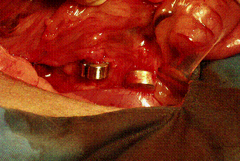 手術例複数のシャント