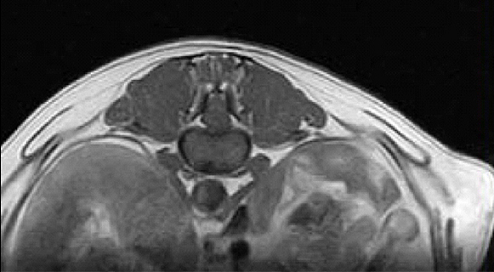 T13-L1の造影なしのT2強調画像