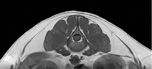 ほぼ正常な椎間板のMRI像