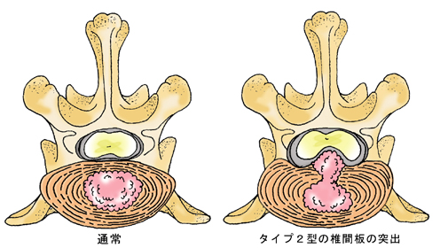 タイプ2型とは