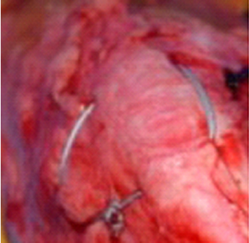 膝蓋骨支持縫合